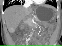 Focal Nodular Hyperplasia (FNH) in Right Lobe - CTisus CT Scan