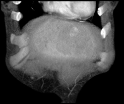 Focal Nodular Hyperplasia (FNH) - CTisus CT Scan