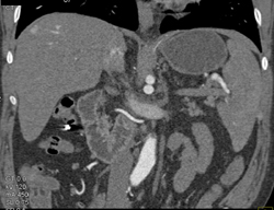 Hepatoma - CTisus CT Scan