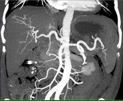 Hepatoma - CTisus CT Scan