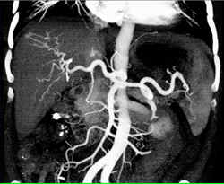 Hepatoma - CTisus CT Scan