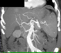 Hepatoma - CTisus CT Scan