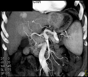 Hepatoma - CTisus CT Scan