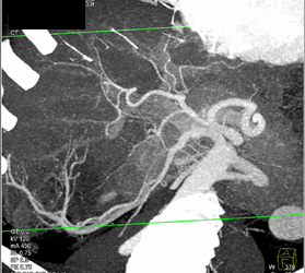 Liver and Splenic Infarct Status Post Liver Transplant - CTisus CT Scan