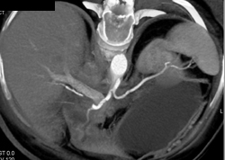 ~1 Cm Hepatocellular Carcinoma (HCC) - CTisus CT Scan