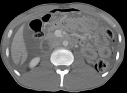 Liver Laceration - CTisus CT Scan