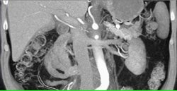 Accessory Hepatic Artery - CTisus CT Scan