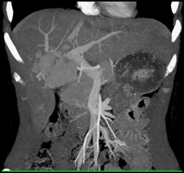 Focal Nodule Hyperplasia - CTisus CT Scan