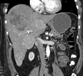 Hepatoma - CTisus CT Scan