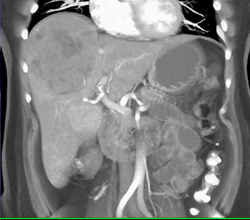 Hepatoma - CTisus CT Scan