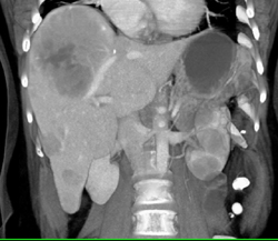 Hepatoma - CTisus CT Scan