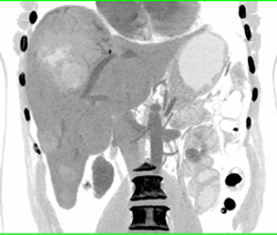 Hepatoma - CTisus CT Scan