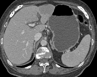 Hepatoma - CTisus CT Scan