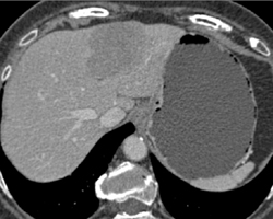 Hepatoma - CTisus CT Scan