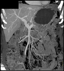 Hepatoma - CTisus CT Scan