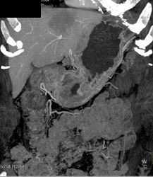 Hepatoma - CTisus CT Scan