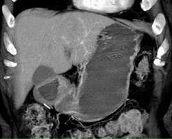 Hepatoma - CTisus CT Scan