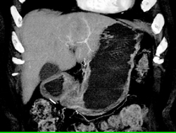 Hepatoma - CTisus CT Scan