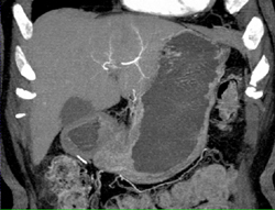 Hepatoma - CTisus CT Scan