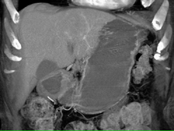 Hepatoma - CTisus CT Scan