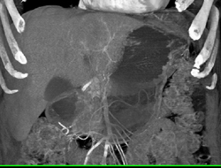 Hepatoma - CTisus CT Scan