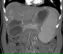 Cirrhosis Hepatocellular Carcinoma (HCC) - CTisus CT Scan