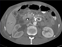 Biliary Stent and Periportal Edema - CTisus CT Scan