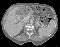 Cholangiocarcinoma - CTisus CT Scan