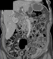 Cholangiocarcinoma - CTisus CT Scan