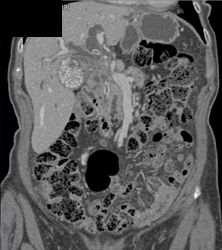 Cholangiocarcinoma - CTisus CT Scan