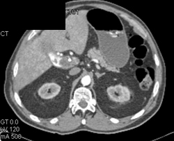 Gallbladder Cancer - CTisus CT Scan