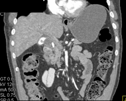 Gallbladder Cancer - CTisus CT Scan