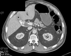 Gallbladder Cancer - CTisus CT Scan