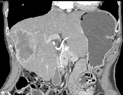 Hepatoma - CTisus CT Scan