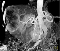 Hepatoma - CTisus CT Scan