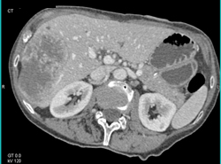 Hepatoma - CTisus CT Scan