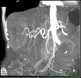 Hepatoma - CTisus CT Scan