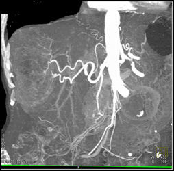 Hepatoma - CTisus CT Scan