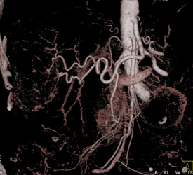 Hepatoma - CTisus CT Scan