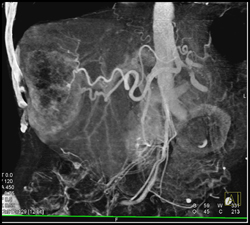 Hepatoma - CTisus CT Scan