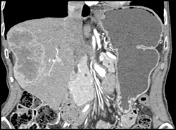 Hepatoma - CTisus CT Scan