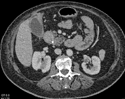 Gallbladder Cancer - CTisus CT Scan