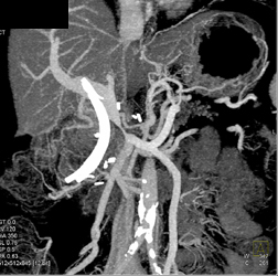 Encased PV/SMV Confluence With Increased Mesenteric Flow - CTisus CT Scan