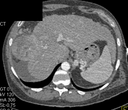 Hepatoma Metastatic to Bone - CTisus CT Scan