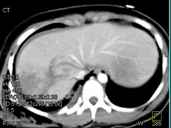 Liver Laceration - CTisus CT Scan