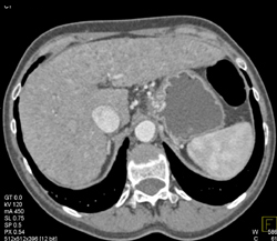 Several Hepatic Necrosis - CTisus CT Scan