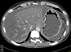 Diffuse Fatty Liver - CTisus CT Scan