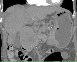 Hepatoma - CTisus CT Scan