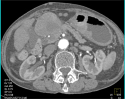 Hepatoma - CTisus CT Scan