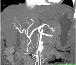 Hepatoma - CTisus CT Scan